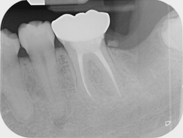 Root canal retreatment and bypass - 12 month review demonstrating healing